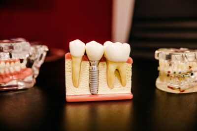 Ventajas y desventajas de las férulas dentales prefabricadas