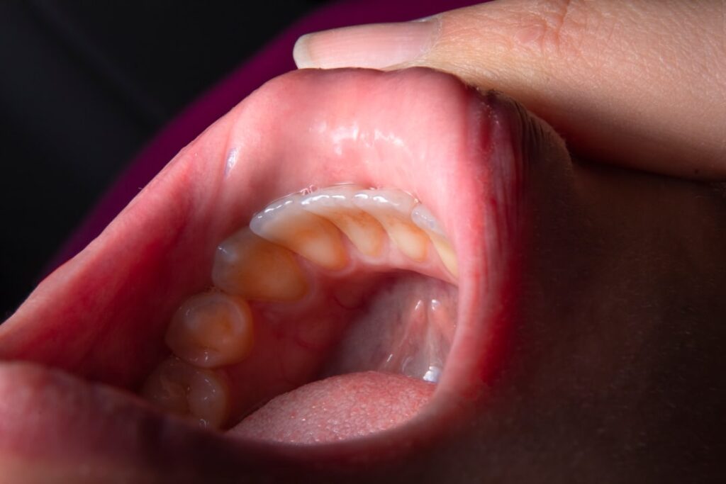 Errores comunes al usar una férula dental y cómo evitarlos