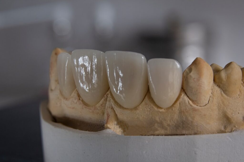 Férula dental: cómo elegir la adecuada para tu caso específico