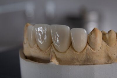 Férula dental: cómo elegir la adecuada para tu caso específico
