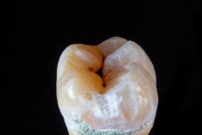Guía paso a paso para el ajuste perfecto de tu férula dental