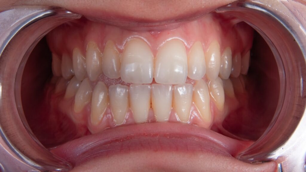 Productos caseros y naturales para limpiar férulas dentales: ¿son realmente efectivos?