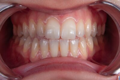 Productos caseros y naturales para limpiar férulas dentales: ¿son realmente efectivos?