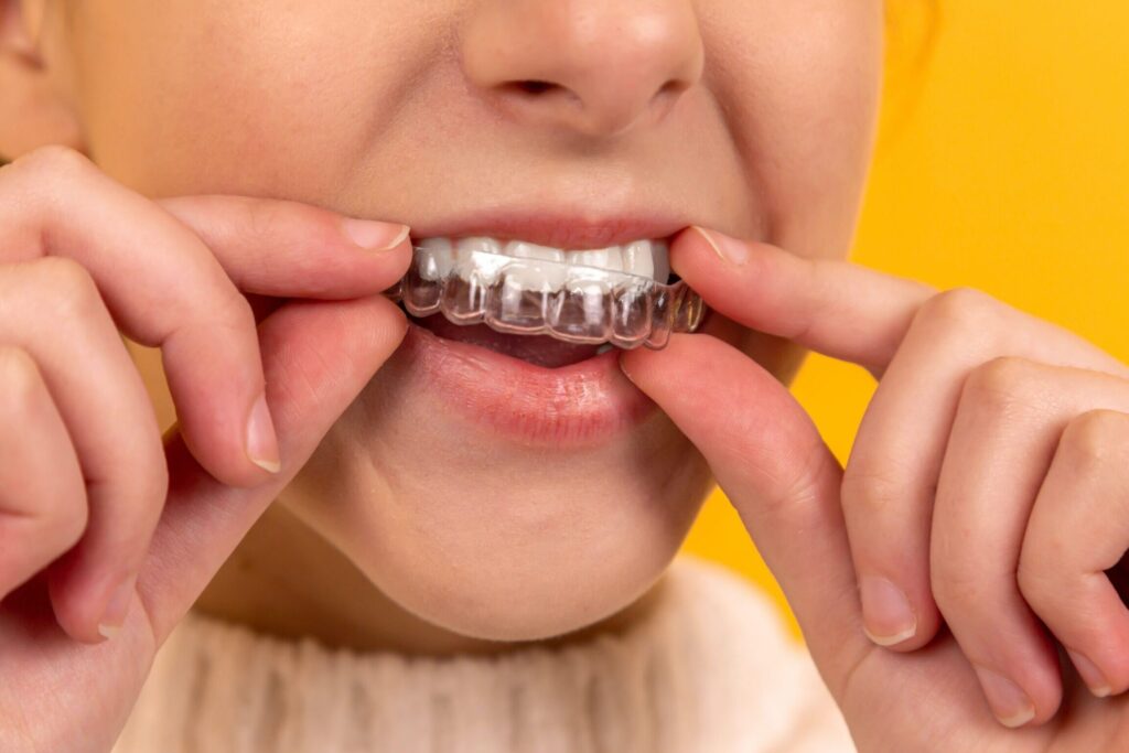 Bruxismo y férula dental: cómo funciona y ayuda a prevenir el desgaste dental