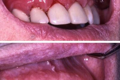 ¿Qué hacer si tienes alergia a los materiales de tu férula dental?