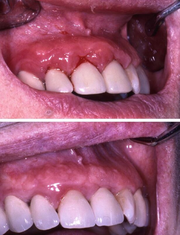¿Qué hacer si tienes alergia a los materiales de tu férula dental?