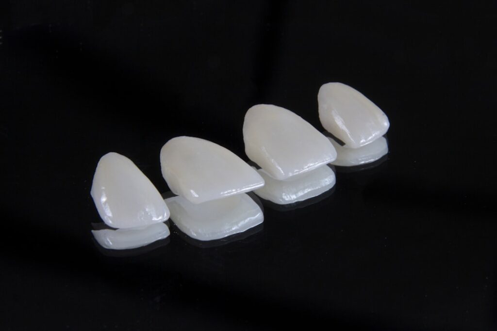 ¿Cómo se fabrica una férula dental a medida?