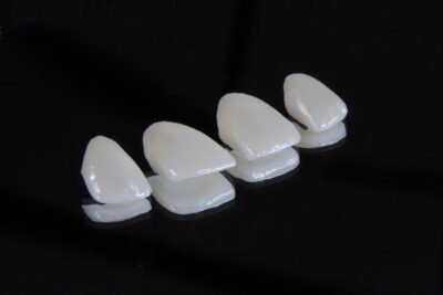 ¿Cómo se fabrica una férula dental a medida?