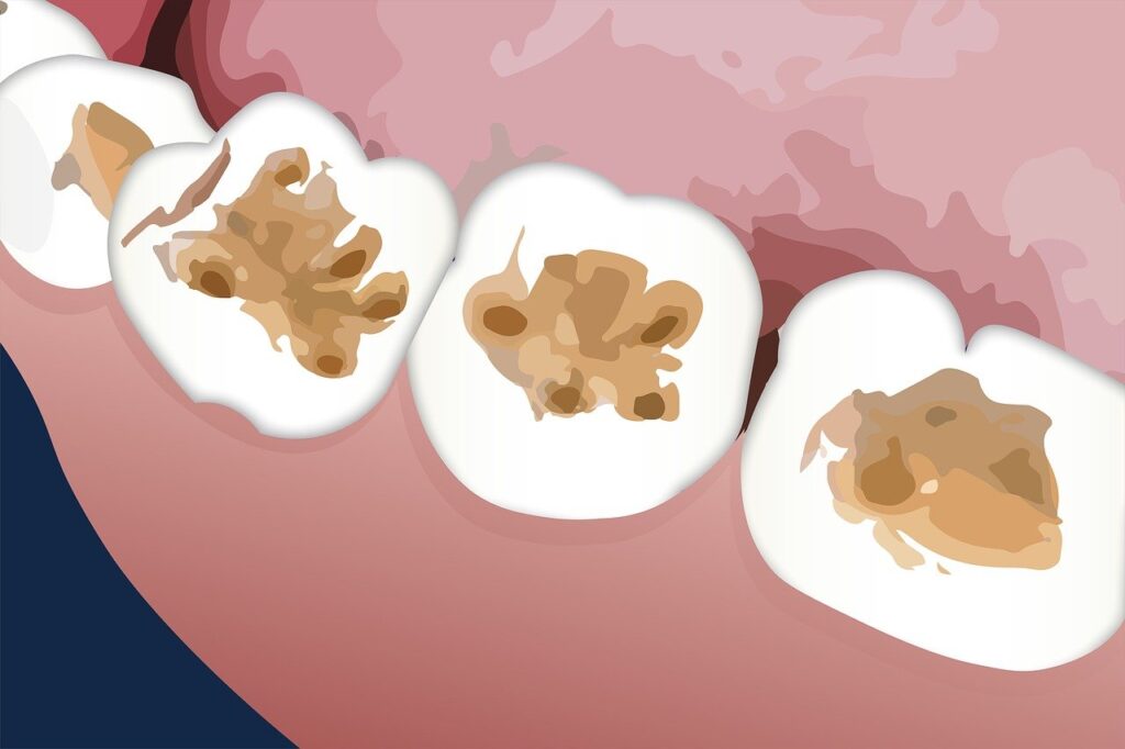 Innovaciones en férulas dentales: la impresión 3D y su impacto en el diseño y comodidad
