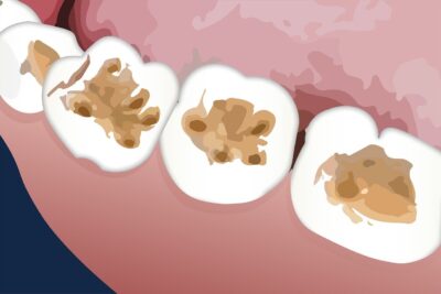 Innovaciones en férulas dentales: la impresión 3D y su impacto en el diseño y comodidad