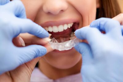 ¿Qué servicios postventa buscar a la hora de adquirir una férula dental personalizada?