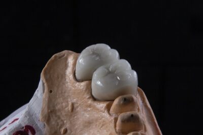 ¿Es necesario usar férulas dentales en deportes sin contacto? Beneficios que quizás no conocías
